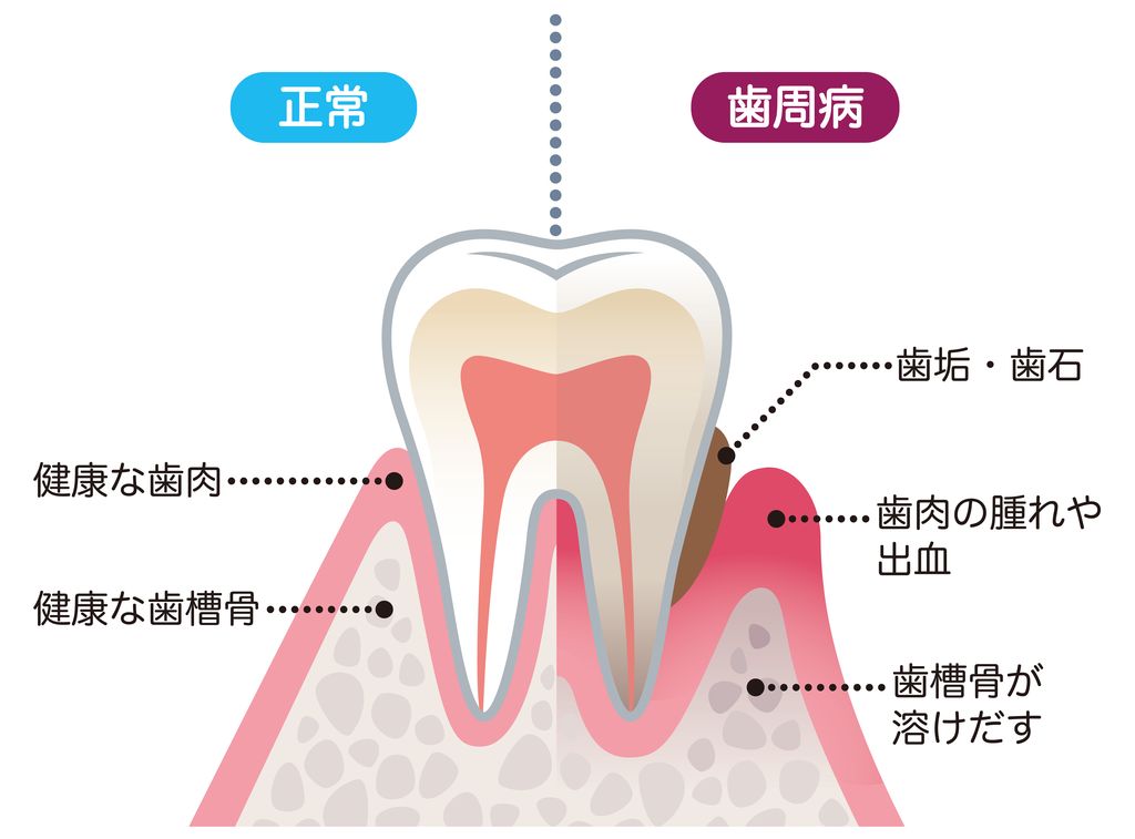 歯周病治療画像04