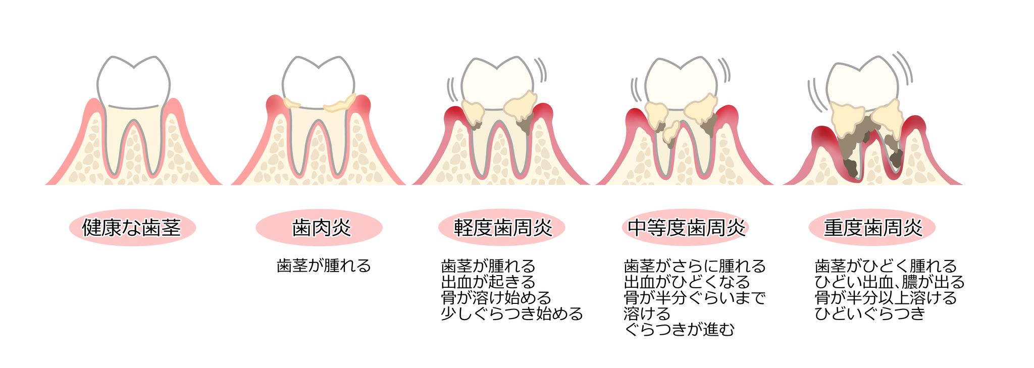 歯周病治療画像05